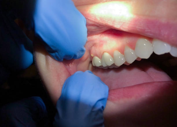 Best Emergency Broken Tooth Repair in Chase, PA